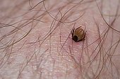 Tick parasitizing the leg of a man France