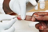 Finger pricked for HIV testing Johannesburg South Africa