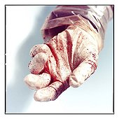 Dried blood on glove & hand of student at the end of autopsy