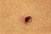 Tick (Ixodes ricinus) biting a human, Territoire de Belfort, France