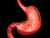 Conceptual image of peptic ulcer in human stomach.