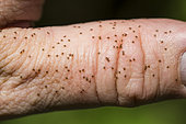 Large number of Sheep tick (Ixodes ricinus) larvae on a thumb, near the Donon, Vosges, France