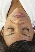 Acupuncture needles in African woman's face