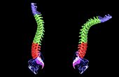 Spondylitis is an inflammatory arthritis that primarily affects the spine. A lateral view of a normal spine (left) and one that is affected by spondylitis (right) is shown.