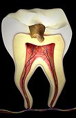 Sectional anatomy of a tooth with decay.