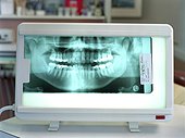 X-ray of teeth
